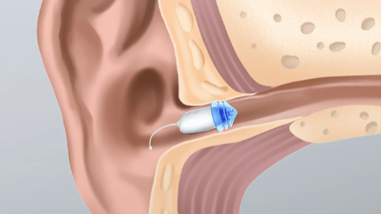 Ceretone Core One’s 60-Day Risk-Free Trial: Is Hearing Aid Worth It?